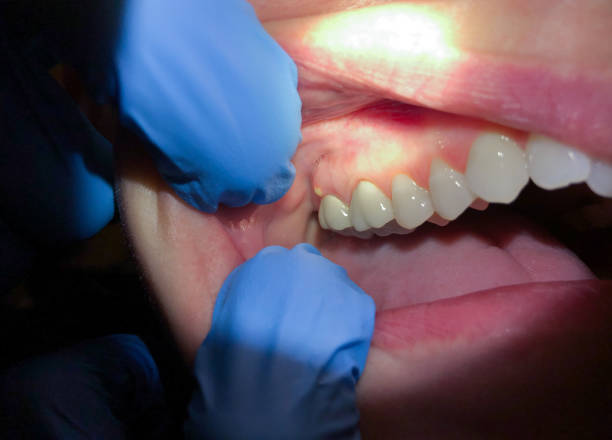 Best Emergency Broken Tooth Repair in North Kingsville, OH